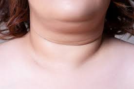 thick neck fat
