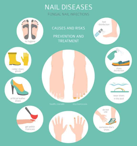 Risk factors of nail fungus