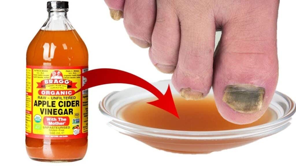 Apple Cider Vinegar for yellow nails