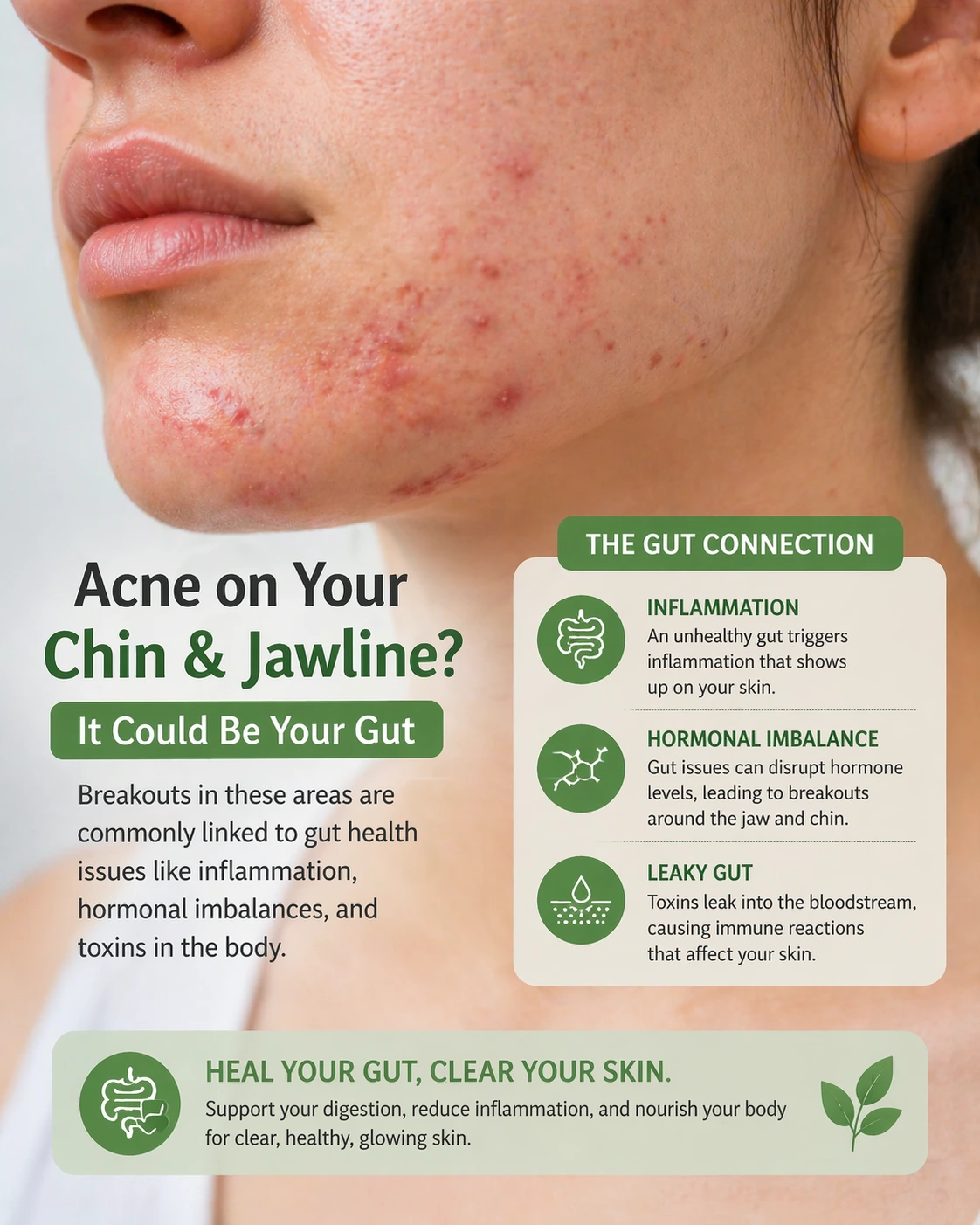 close up of skin with acne breakouts on chin and jaw area commonly linked to gut health issues