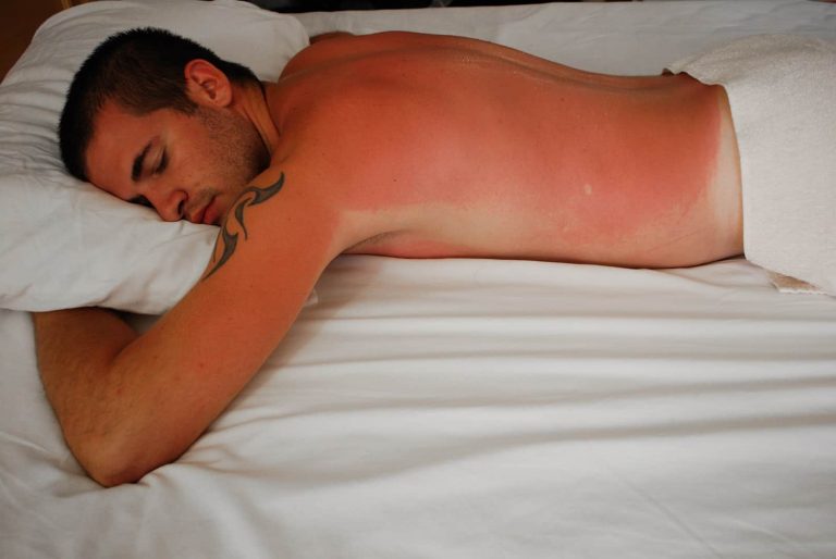 How to sleep with sunburn