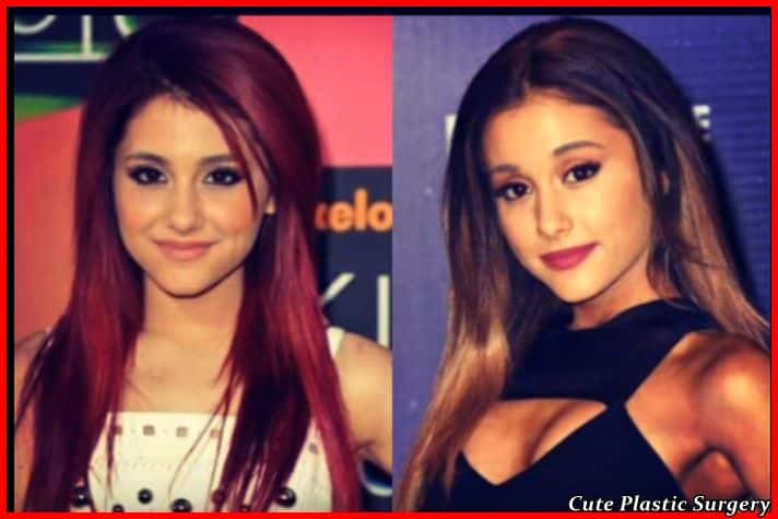 Ariana Grande plastic surgery before and after pictures 2