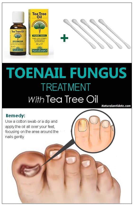 Tea tree oil for tonenail fungus treatment