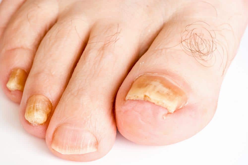 toenail nail fungus