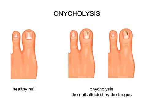 Onycholysis