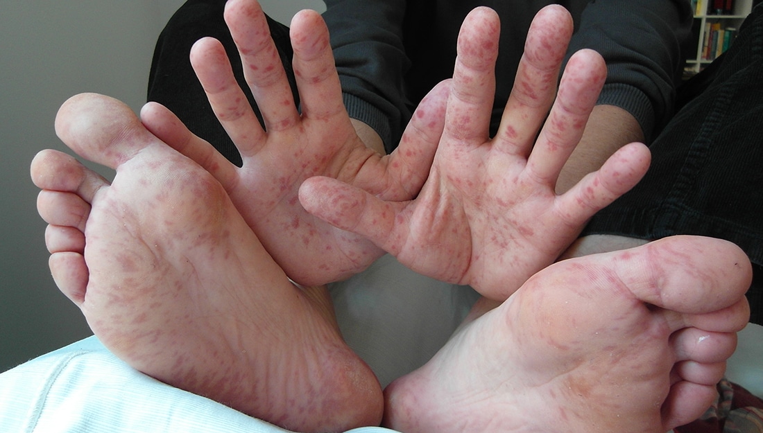 What Is Hand Foot And Mouth Disease