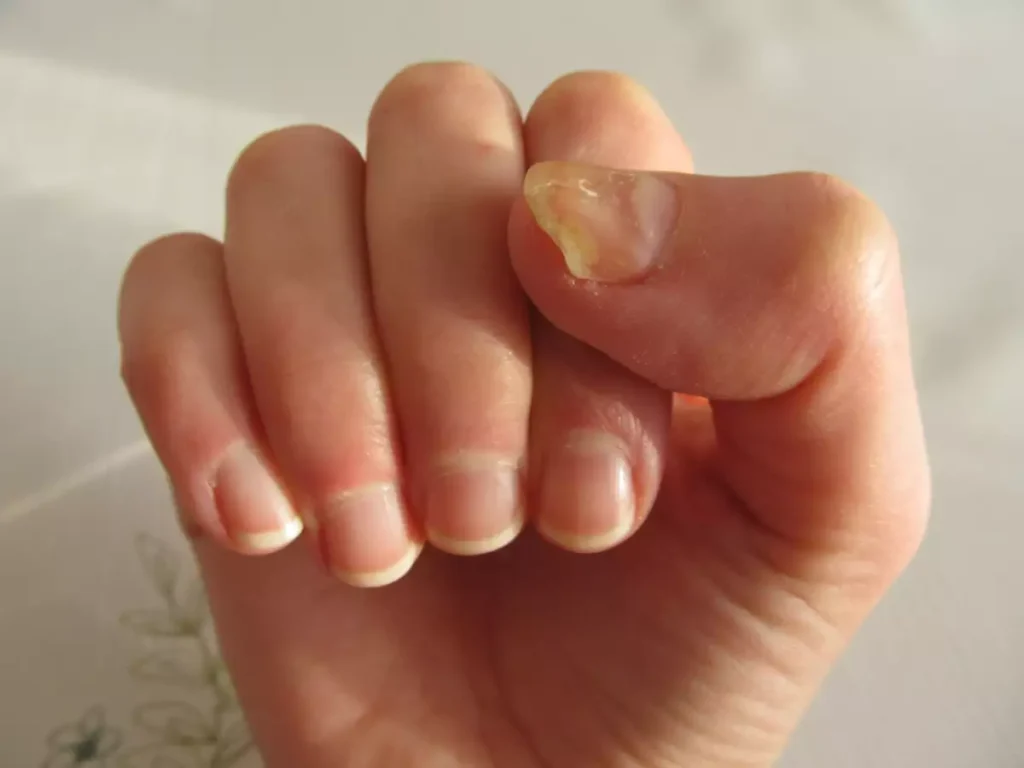 Growth of fungus in nails