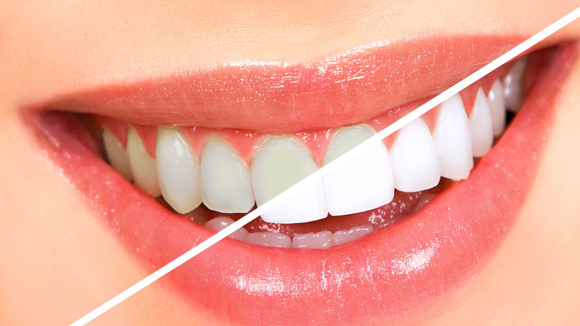 Professionals Tips for Better White Teeth and a Smile!