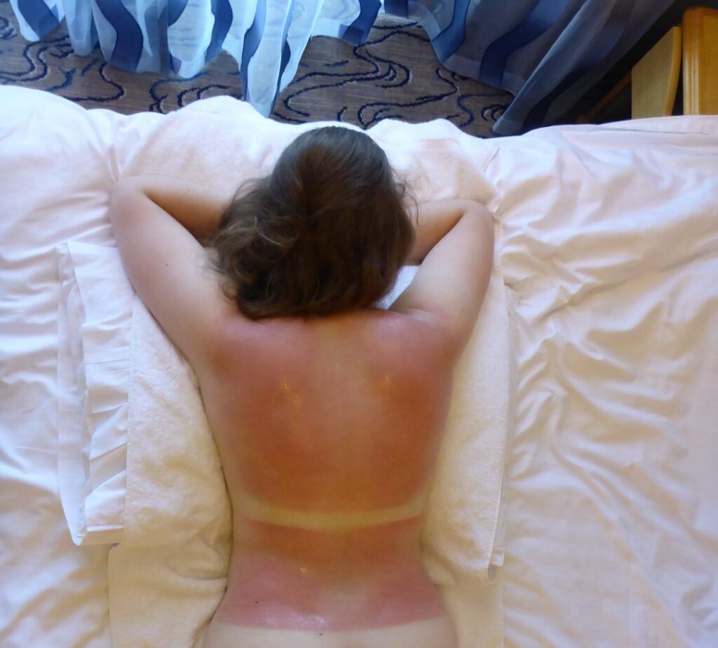 Why Do Sunburns Feel Worse at Night
