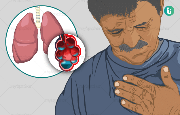 Symptoms of Pulmonary Edema
