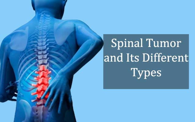 Treatments for spinal tumor
